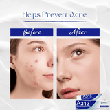 ✨ Get Clear, Radiant Skin Fast ✨ Ultimate A313 + HA Skincare Duo - For All Ages